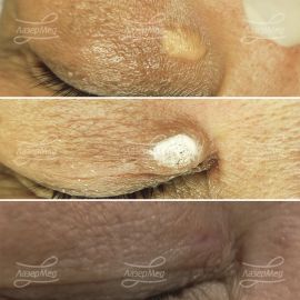 Удаление ксантелазмы на веке, до - сразу после, и спустя 20 дней