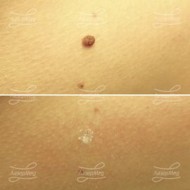Удаление смешанного невуса на туловище (До и сразу После)