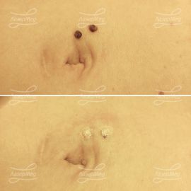 Удаление смешанные невусов на животе (До и сразу После)