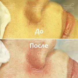 Удаление сосудов на крыльях носа (До и сразу После)