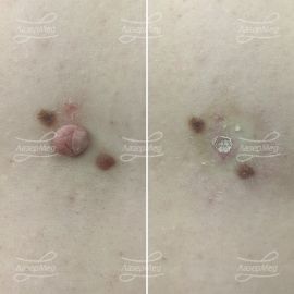Лазерная деструкция невусов (До и сразу После)