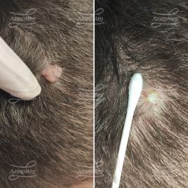 Лазерная деструкция невусов (До и сразу После)