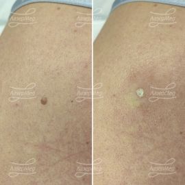 Лазерная деструкция невусов (До и сразу После)