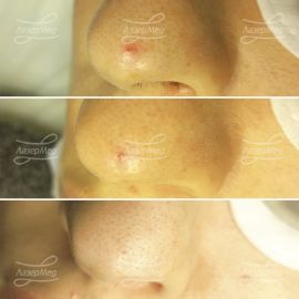 Удаление гемангиомы на носу (До и сразу После и Через месяц после процедуры)