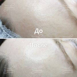 Проведение всесезонного пилинга biorepeel (До и сразу После. Без покраснения)