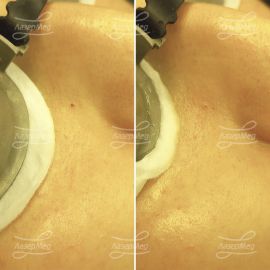 Удаление точечной гемангиомы на лице (До и сразу После)