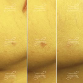 Удаление пигментного пятна на лице (До и сразу После и Через 2 недели после процедуры)