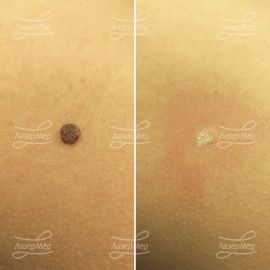 Удаление смешанного невуса на туловище (До и сразу После)