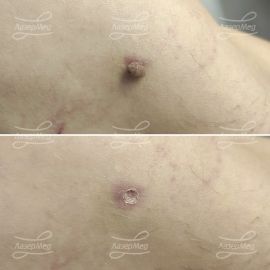 Лазерная деструкция невусов (До и сразу После)