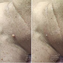 Лазерная деструкция невусов (До и сразу После)