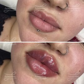 Контурная пластика губ