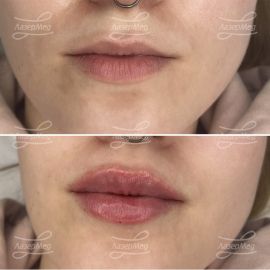 Контурная пластика губ
