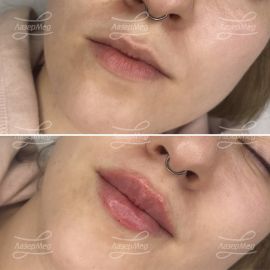 Контурная пластика губ