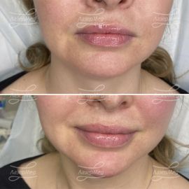 Коррекция подбородка