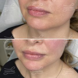 Коррекция подбородка