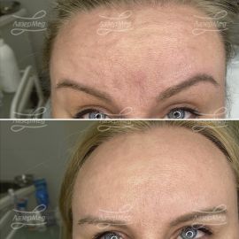 Инъекции ботокса