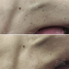 Лазерная деструкция кератом и папиллом на коже (До и через 10 дней)