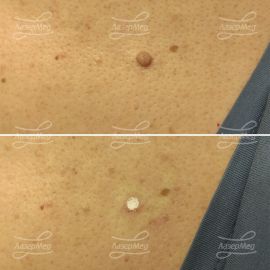 Лазерная деструкция фибромы (До и сразу После)