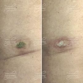 Лазерная деструкция кератомы на коже спины (До и сразу После)