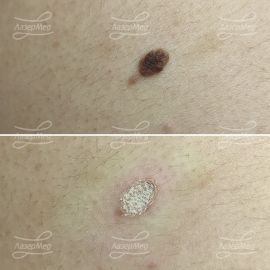 Лазерная деструкция невуса