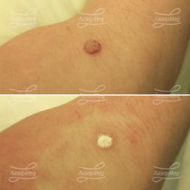 Удаление бородавки на кисти (До и сразу После)