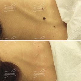 Удаление папиллом на шее (До и сразу После)