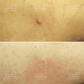 Удаление фибромы на шее (До и сразу После)