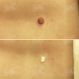 Удаление сложного невуса в поясничной области (До и сразу После)