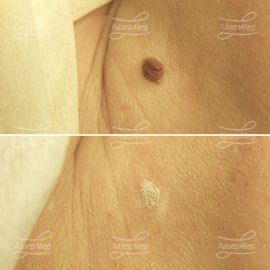 Удаление сложного невуса на шее (До и сразу После)