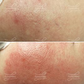 Удаление мелких сосудов на щеках (До и сразу После)