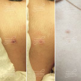 Удаление травмированного невуса на шее (До - сразу После - и вид рубчика спустя 20 дней, он ещё будет светлеть)