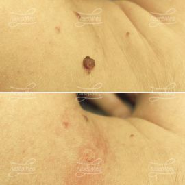 Удаление сложного невуса на шее (До и сразу После)