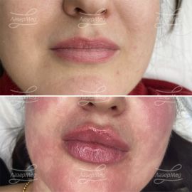 Контурная пластика губ