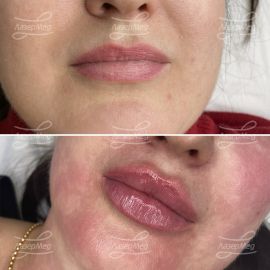 Контурная пластика губ