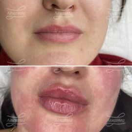 Контурная пластика губ