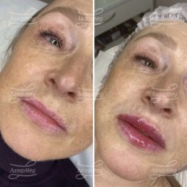 Контурная пластика губ