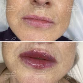Контурная пластика губ