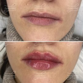 Контурная пластика губ
