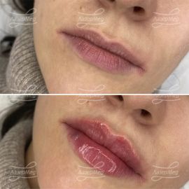 Контурная пластика губ