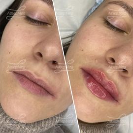 Контурная пластика губ