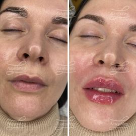 Контурная пластика губ