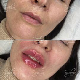 Контурная пластика губ