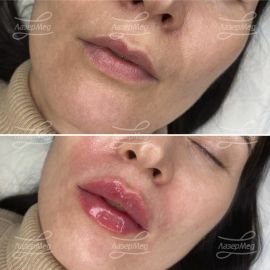 Контурная пластика губ