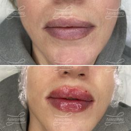 Контурная пластика губ