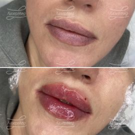 Контурная пластика губ