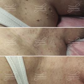 Лазерная деструкция фибром и папиллом(До - сразу После - и через 14 дней)