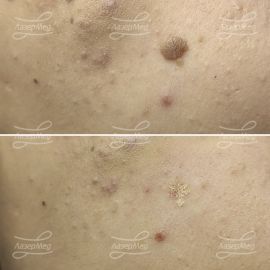 Лазерная деструкция кератомы (До и сразу После)
