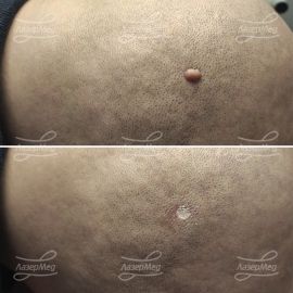 Лазерная деструкция фибромы на коже волосистой части головы (До и сразу После)