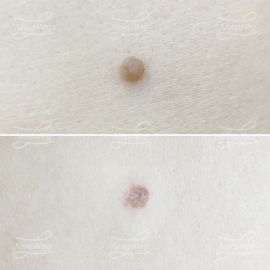 Лазерная деструкция невуса (До и сразу После)