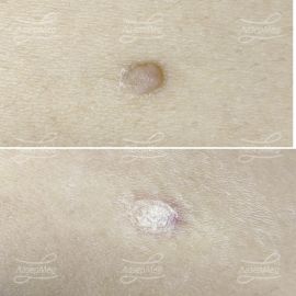 Лазерная деструкция невуса (До и сразу После)